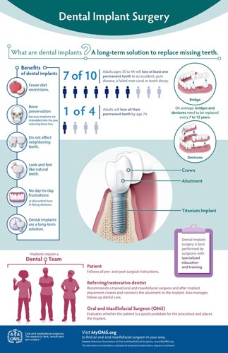 dental_implant_surgery_infographic-tile